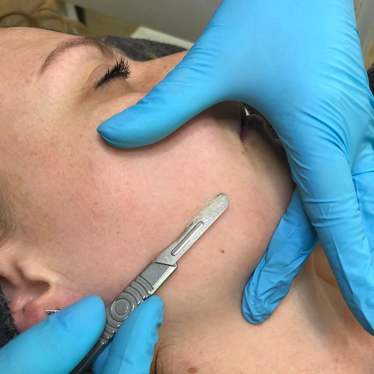 dermaplaning