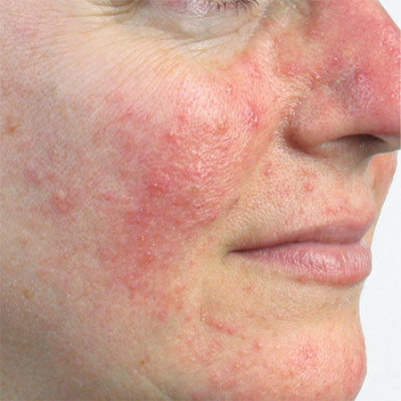 Huidaandoening-Rosacea-behandeling-Huid-Laser-kliniek-Utrecht